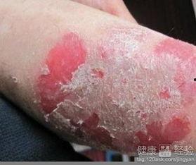 明星 银屑病,勇敢面对挑战的他们