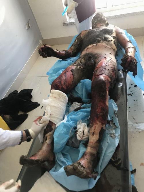 烧伤照片,疤痕与康复的见证